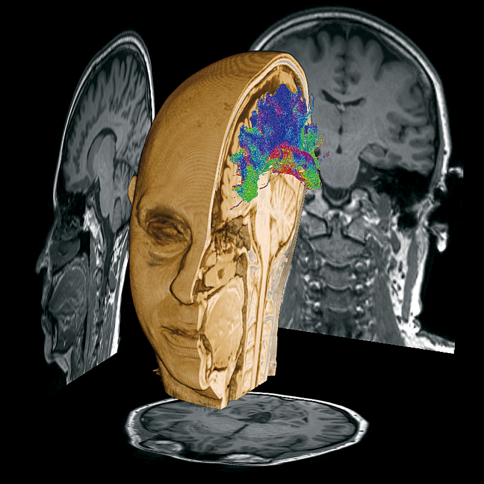 Ressonância magnética do mapa de conectividade estrutural cerebral de Fernanda