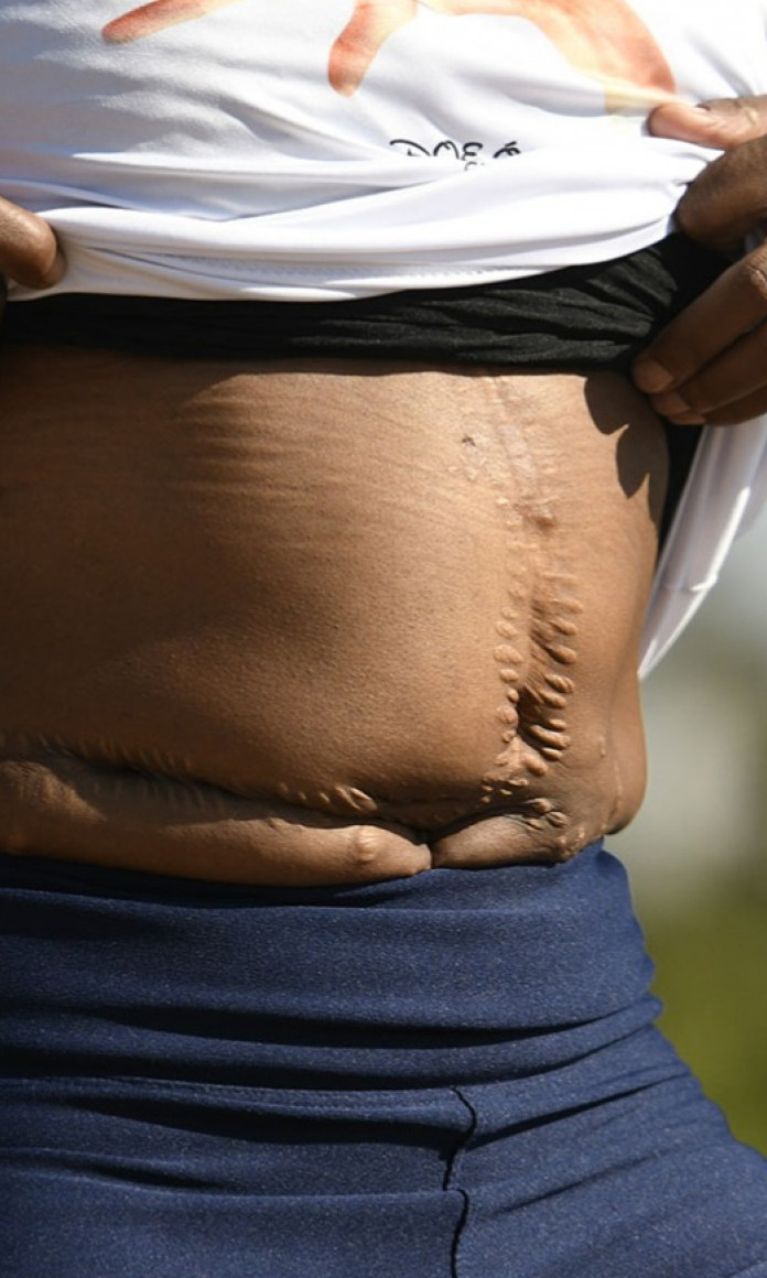 Barriga de uma cicatriz com uma cicatriz do transplante de orgao