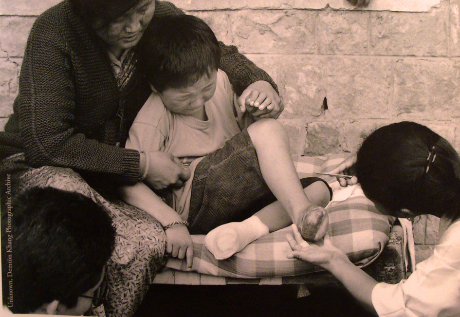 Criança refugiada amputada