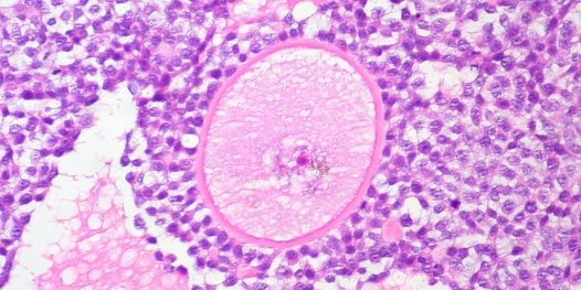 Procura-se doadora de óvulos – US$1.500