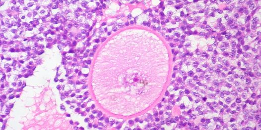 Procura-se doadora de óvulos – US$1.500